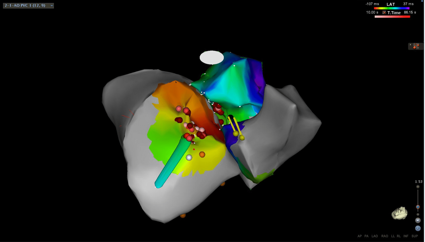 Image 2 - Cranial to caudal view of the 3D map demonstrating ablation lesions for case 3.